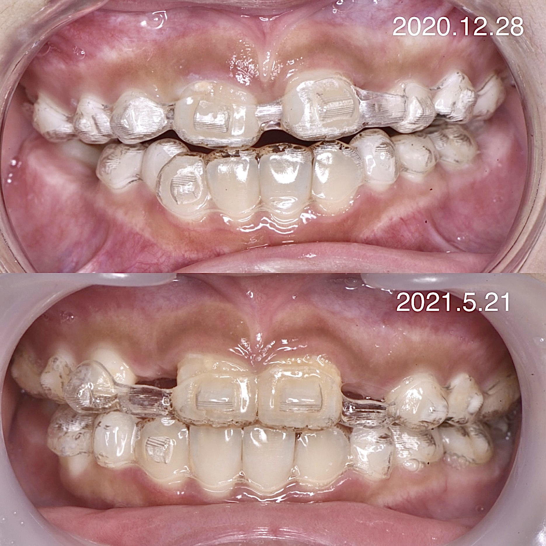 小児用マウスピース矯正👦🏻👧🏻✨ | 荻窪ツイン歯科医院 インビザライン専門サイト